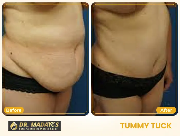 Tummy tuck before and after result 6 at Dr Madan Aesthetics